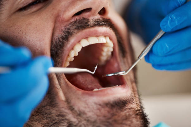 Best Emergency Tooth Extraction in Stanton, MI